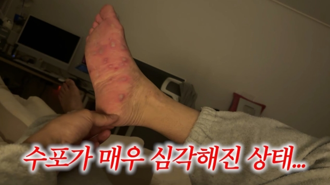 아이들병 아니었어?…"물집 생기더니 손·발톱 빠져" 어른도 치명적