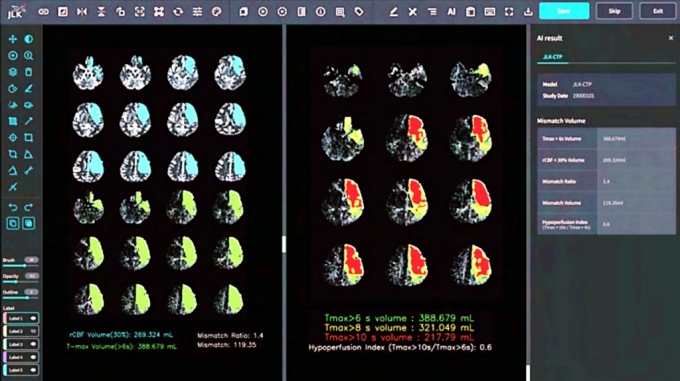 뇌 관류 영상 분석 AI 솔루션인 'JLK-CTP' 구동 모습./사진=제이엘케이