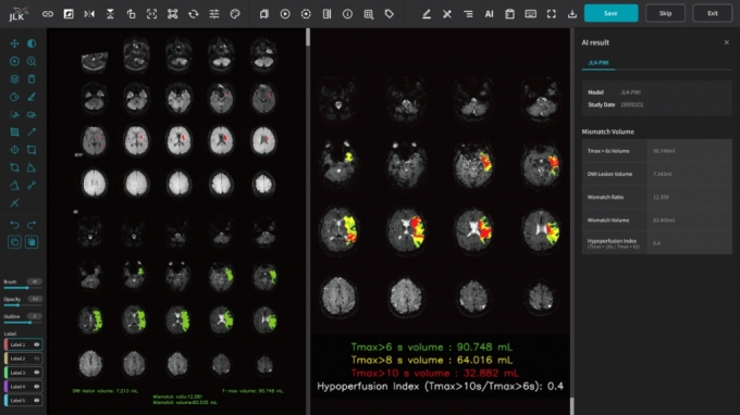 제이엘케이 뇌관류 MR 영상 분석 솔루션 'JLK-PWI'의 구동화면./사진=제이엘케이