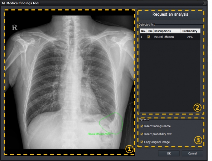 VXCAD-CXR 솔루션이 엑스레이 촬영 대상의 흉부 영상에서 흉수에 대한 진단 소견을 내리는 모습./사진=뷰웍스