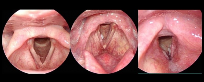  후두에 생긴 물혹(맨 왼쪽), 바이러스로 인한 사마귀 조직(가운데)과 달리, 단단하고 꽉 채워진 혹(맨 오른쪽)이 후두암이다. /사진=서울시보라매병원