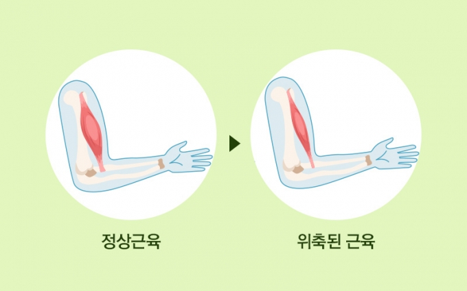 루게릭병-근위축./사진제공=나누리병원