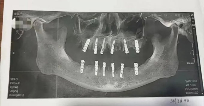  중국에서 하루 만에 치아 23개를 뽑고 12개 임플란트를 심는 대규모 수술을 받은 남성이 얼마 지나지 않아 사망해 논란이 되고 있다./사진=SCMP