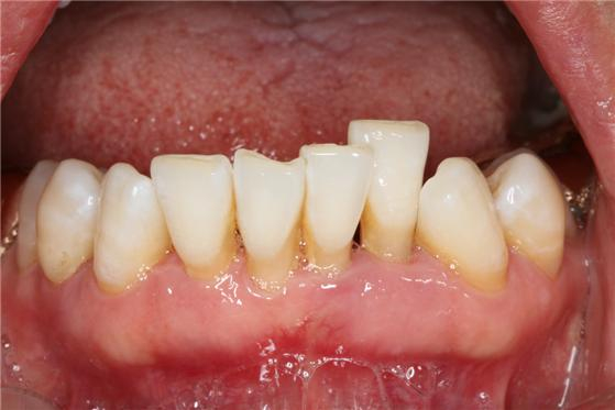 치주질환과 정출로 인해 잇몸이 퇴축되고 치아 뿌리가 상당 부분 드러난 모습. /사진=관악서울대치과병원