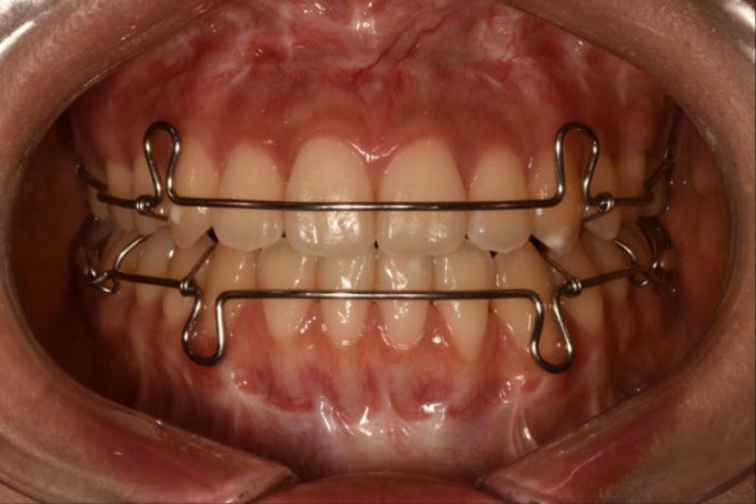가철식 유지장치를 착용한 모습. /사진=서울대치과병원