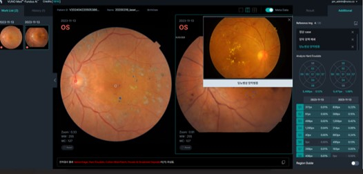 '뷰노메드 펀더스 AI(VUNO Med-Fundus AI) 이미지. /사진제공=뷰노