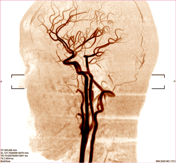 뇌혈관을 찍은 MRI 사진. 