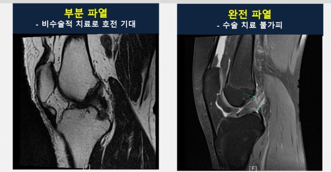 전방십자인대 파열 시 치료  전략./사진=바른세상병원