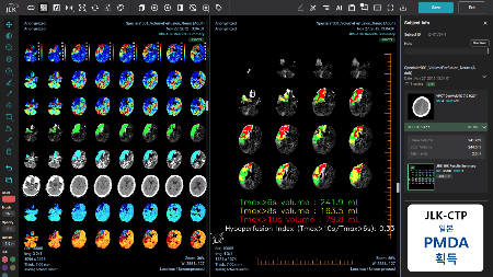 제이엘케이 뇌졸중 AI 솔루션 'JLK-CTP' 구동 모습. /사진=제이엘케이