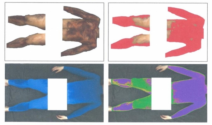 '파란색 쫄쫄이'로 불리는 변색의복(왼쪽 아래)를 입고 TSTm이라는 신경검진기에서 땀을 내면, 변색 부위를 컴퓨터가 분석해 통증 원인 부위·질환을 찾아낸다./사진=쎄이엠  