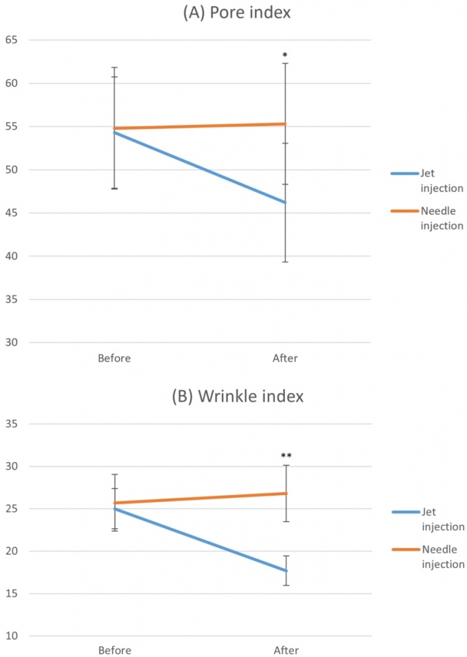 필러 무침 주사(Jet injection)와 바늘주사(Needle injection)의 모공(A그래프)과 주름(B그래프) 개선율 비교. 모공지수는 시술 후 바늘주사군이 55.3, 무침주사군이 46.2이고, 주름지수는 시술 후 바늘주사군이 26.8, 무침주사군이 17.7로 나타났다. /자료=중앙대병원