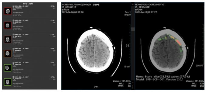 메디컬 인사이트 플러스 뇌출혈 동작 화면/사진제공=퍼플AI