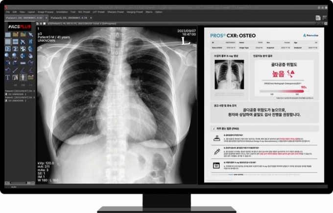  골다공증 진단 보조 AI 소프트웨어 &#039;PROS® CXR: OSTEO&#039;/사진제공=프로메디우