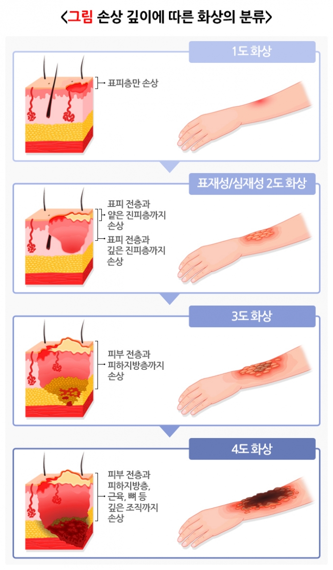 텐트서 살충제 뿌리다 전신 화상…'캠핑 사고 1위' 화상 대처법 - 머니투데이