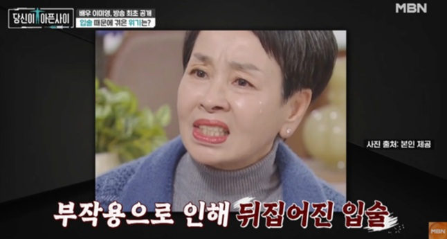 이미영 "공업용 실리콘 시술에 입술 다 뒤집어져…일 다 끊겼다"