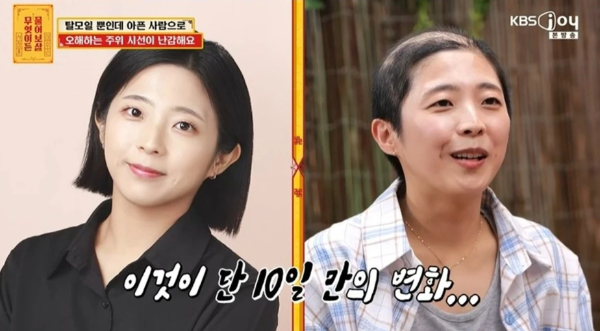 "10일 만에 급성 탈모"…30대 여성 모자 벗자 '깜짝'