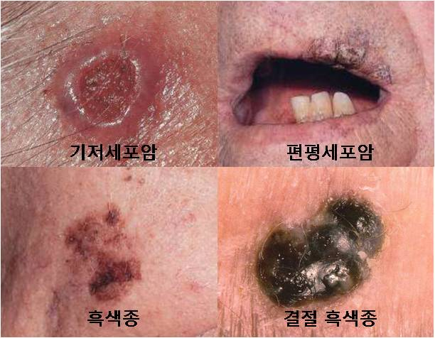 얼굴에 난 왕점인 줄 알았는데, 암이었어? 헷갈린다면 'ABCDE'