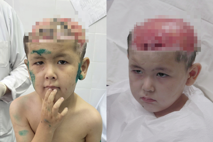 개 3마리가 공격, 머리뼈 드러나…키르기스스탄 아이, 한국서 재건 성공