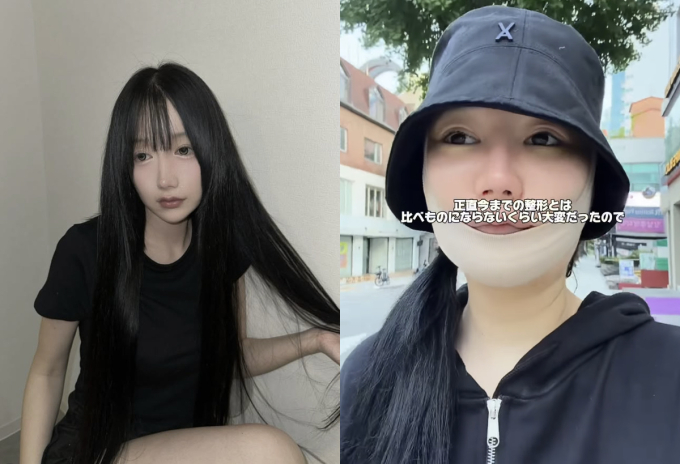 "한국서 수술 받고 입·턱 마비 상태"…日인플루언서 부작용 호소