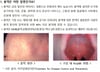 "베트남 갔다가 42명 감염"…3주 내 발열·발진 증상 나타났다