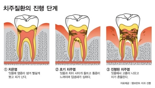 ↑ 치주질환 진행단계