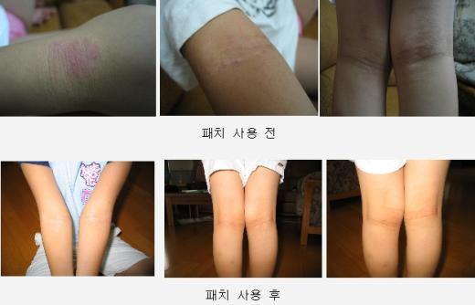 ▲ 패치 사용 전후 치료효과