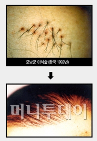 ↑ 대구 경북대병원의 모낭이식술인 '모낭군 이식술' 시술 전후 모습.
