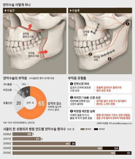 양악 수술을 받기 전(왼쪽)과 후의 모습.