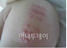 ↑ 도장방식의 BCG접종. 7만원 정도를 부담해야 한다.