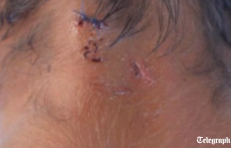 ↑요안 갤러란(29)이 악어에게 공격을 받아 머리 뒷부분에 부상을 입었다. 사진은 목 부위 악어에 물린 상처.(ⓒ텔레그라프 동영상 캡처)