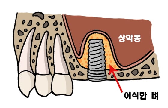/삽화=김효정 치위생사(임플란티아 치과 삼성점)