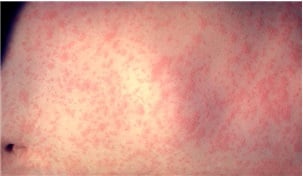 홍역 발진/사진 출처=미국질병관리본부(Centers for Disease Control and Prevention)