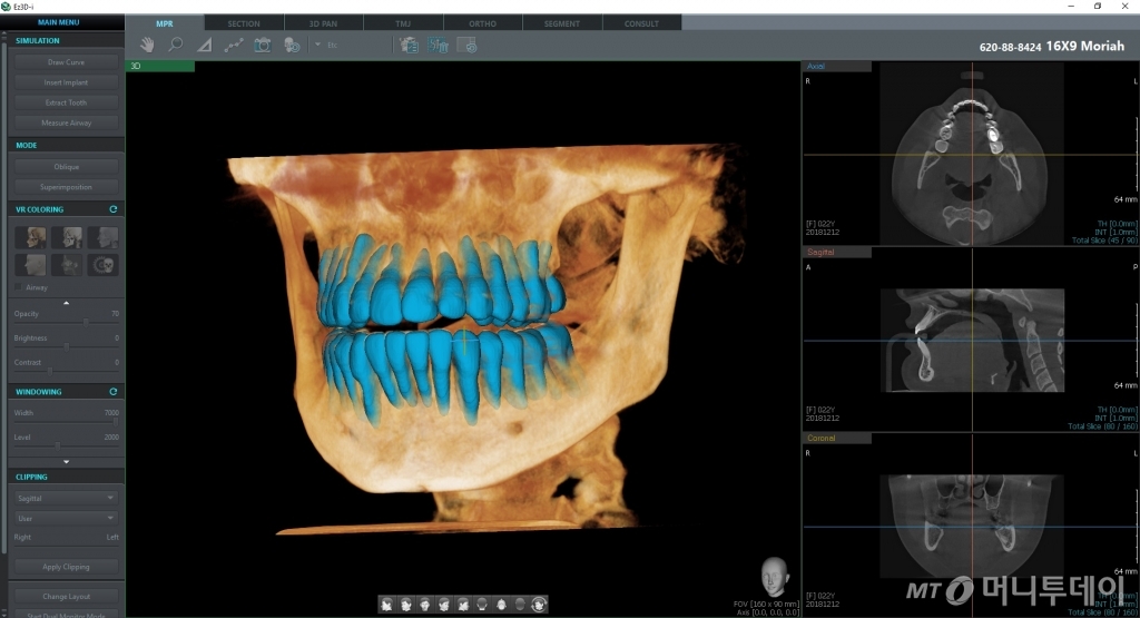 Ez3D-i의 치아-뼈 분리 기능 화면/사진제공=바텍