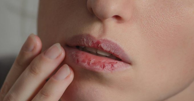 갈라진 입술. / 사진 = 트위터