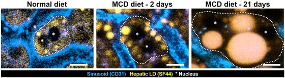 간세포 내 크기가 큰 지방구 (Lipid droplet, 황색 ) 형성으로 인한 간세포 핵 (*) 의 위치변화 및 간세포의 모양 변화 ( 점선 ) 를 보여주는 생체현미경 영상 결과/자료=KAIST