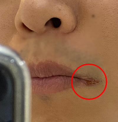 입술 오른쪽에 이렇게 수포가 났다. 너무 달렸나./사진=입을 크게 못 벌리는 남형도 기자