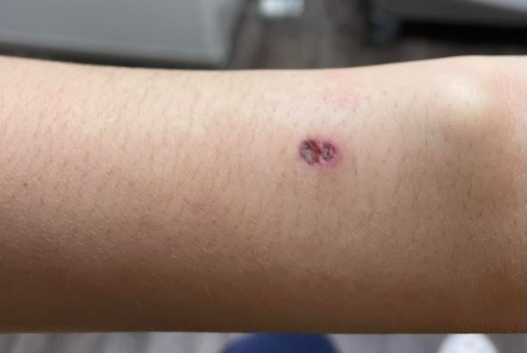 애플워치4를 착용한 뒤 A씨 손목에 생긴 상처. 센서모양과 유사한 형태의 궤양이 생긴 모습. /사진=본인 제공