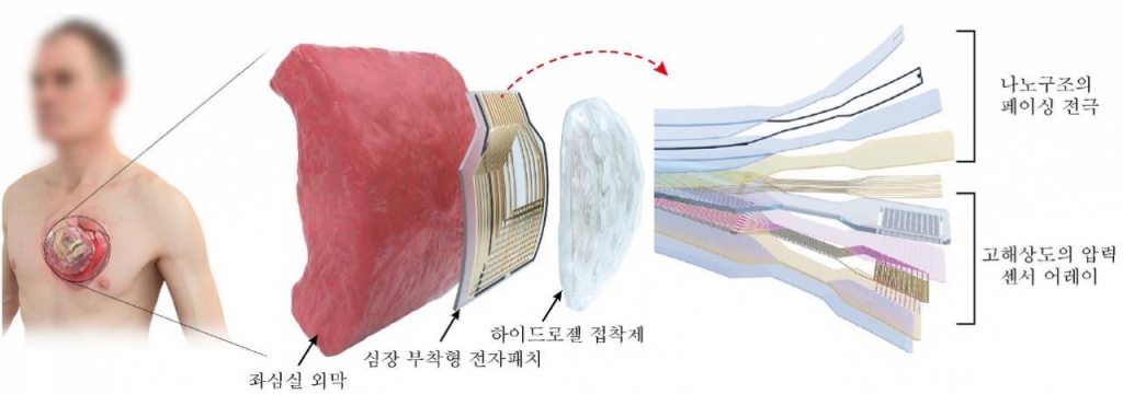 기초과학연구원(IBS) 연구팀이 연세대 세브란스병원 심장혈관외과 연구팀과 공동으로 부정맥을 진단·치료할 수 있는 전자패치를 개발했다. / 사진제공=기초과학연구원(IBS)