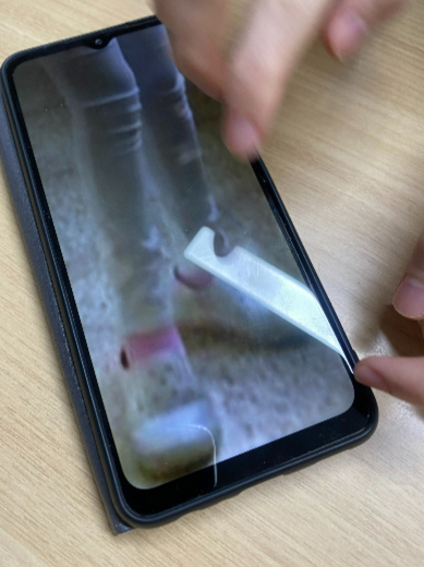 초등학교 4학년 때, 근육병으로 인해 걷는 게 불편했던 신선아씨. 까치발을 들고 다녀야 했단다./사진=남형도 기자