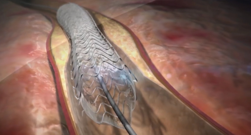 스텐트 적용 모습. 콜레스테롤과 지방으로 막힌 혈관을 넓혀주는 합금 재질 지지체와 지지체 안 또는 밖에 붙이는 튜브로 이뤄진다. 튜브는 두께가 마이크로미터 단위로 얇아야 하고 혈액 속 영양소와 체내 노폐물은 통과하지 혈액은 빠져나가지 못하도록 해야 한다./사진제공=웰크론.