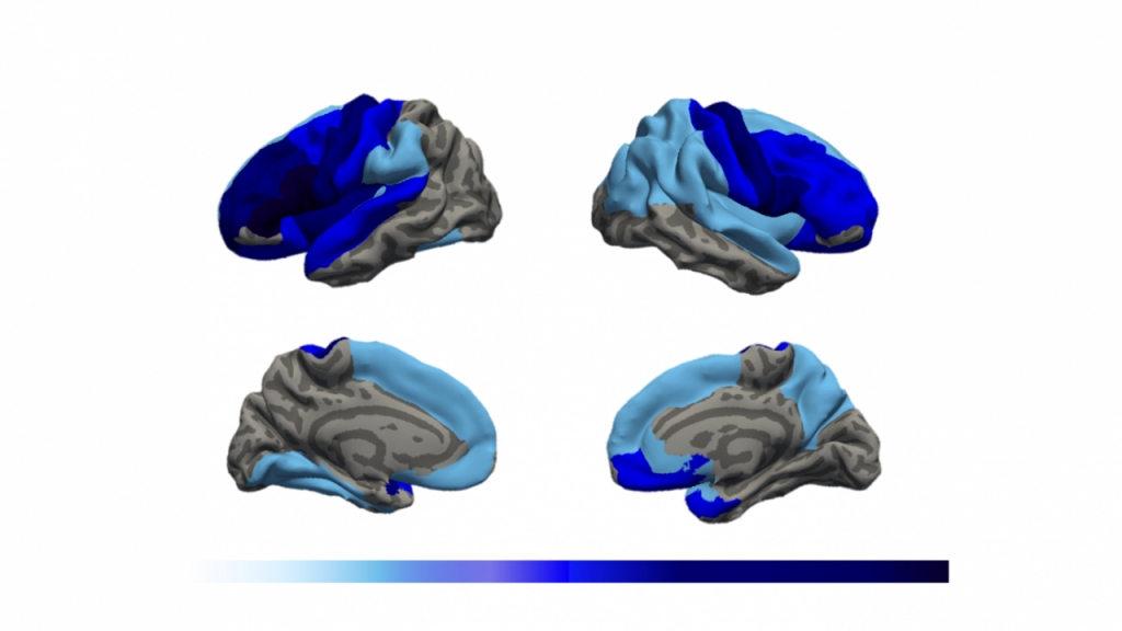 대뇌의 바깥쪽(사진 위)와 , 안쪽의 MRI 촬영 영상. 짙은 파란색일수록 뇌 주름의 정도가 감소되어 있음을 의미한다. /사진=고대안암병원