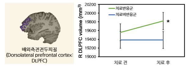 항우울제 치료 전후 배외측 전전두피질 부피의 변화. R은 오른쪽(right)을 의미한다. /그림=서울대병원