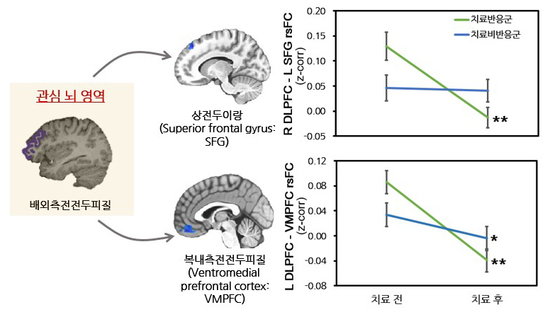 항우울제 치료 전후 배외측 전전두피질 휴지기 기능적 연결성의 변화. R은 오른쪽(righ), L은 왼쪽(left)이다. /그림=서울대병원