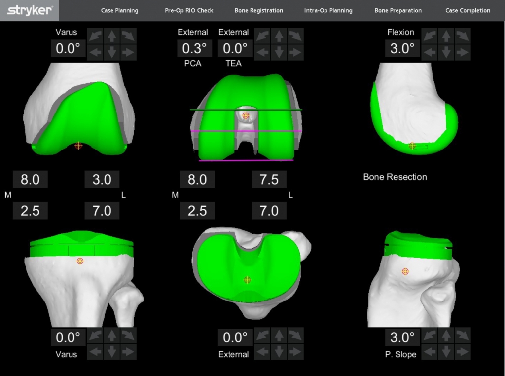 마코 로봇 수술 화면./사진=한국스트라이커