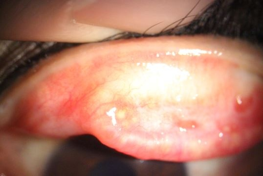 결막결석 환자의 눈꺼풀을 뒤집으니 하얗고 노란색 돌이 알알이 박혀있다./사진=순천향대부천병원