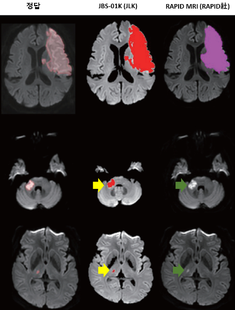 작은 뇌경색 병변에 대한 뇌졸중 전문의 정답((사진 왼쪽 첫번쨰)과 비교해 JLK의 'JBS-01K'는 병변을 정확히 탐지했지만(사진 왼쪽 두번쨰, 노란색 화살표), RAPID MRI는 탐지하지 못했다./사진=제이엘케이