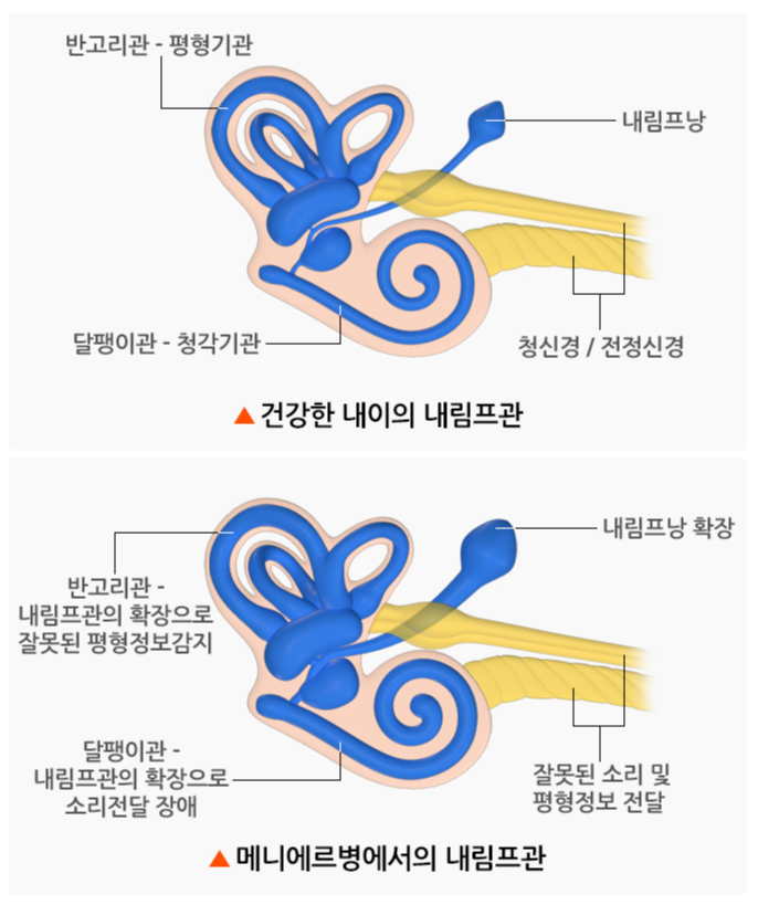 메니에르병의 주요 원인으로 추정되는 내림프 수종 모식도./사진=질병관리청 국가건강정보포털