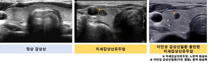 갑상선 초음파 장면. 사진 왼쪽부터 정상 갑상선, 미세 갑상선 유두암, 미만성 갑상선 질환이 동반된 미세 갑상선 유두암./사진=서울대병원