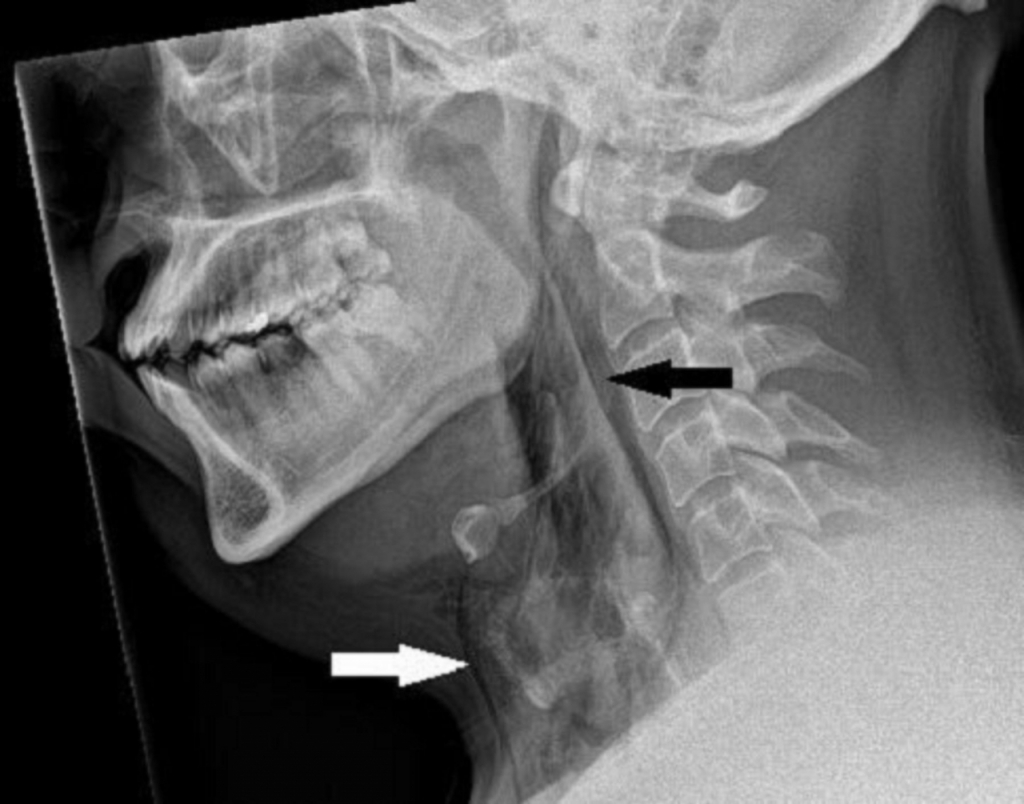 재채기를 참은 30대 스코틀랜드 남성이 기관지와 목 부위에 미세 손상을 입은 부위(화살표). / 사진=BMJ Case Reports