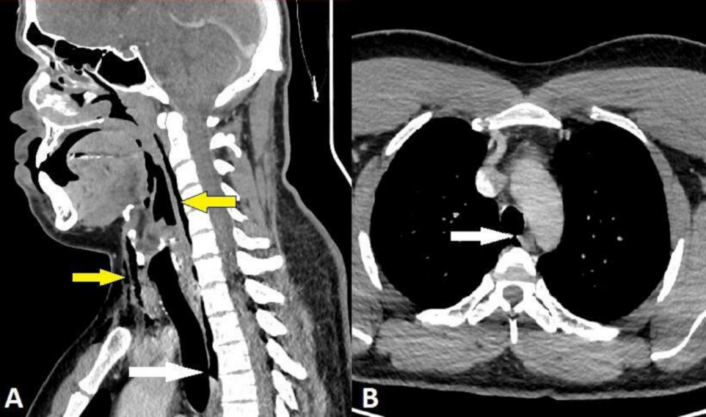  기관지와 목에 손상을 입은 부위(A)와 30대 남성이 찢어진 부위 클로즈업(B)./ 사진=BMJ Case Reports